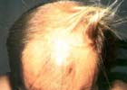 Cancro: diminuir a queda de cabelo